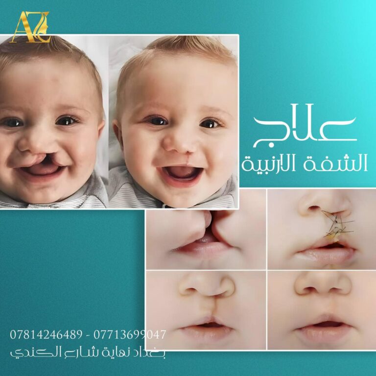 علاج الشفه 1 768x768