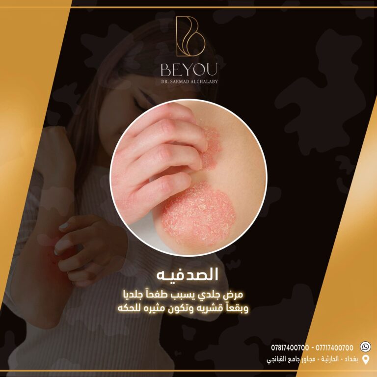 علاج الصدفيه 768x768