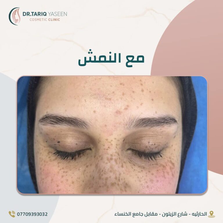 علاج النمش 768x768