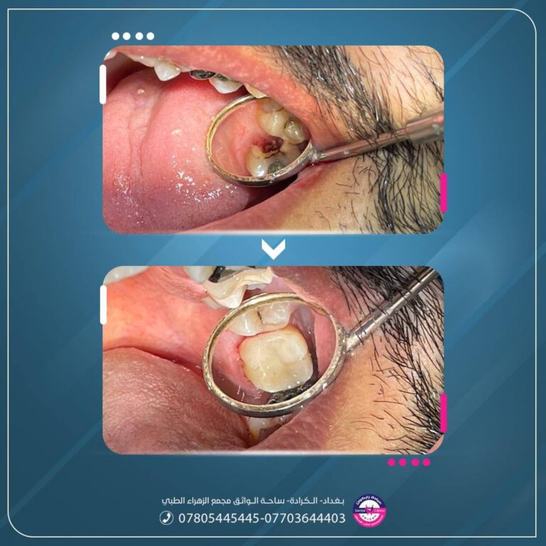 عمل حشوه 768x768