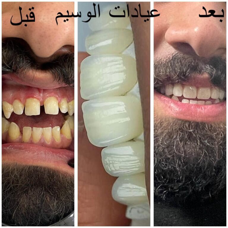 عمل راىع قبل وبعد 1 768x768