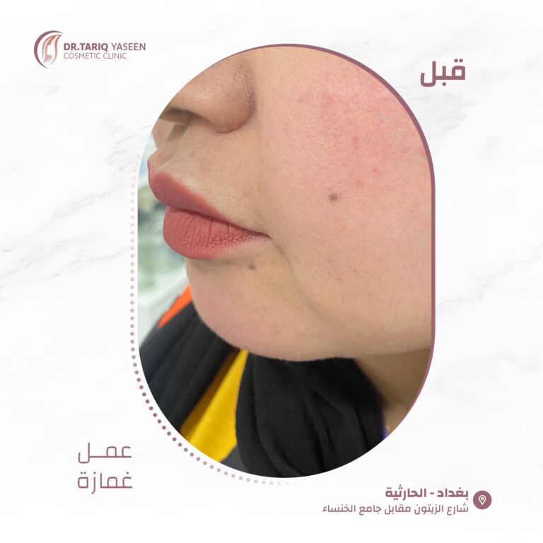 عمل غمازه 768x768