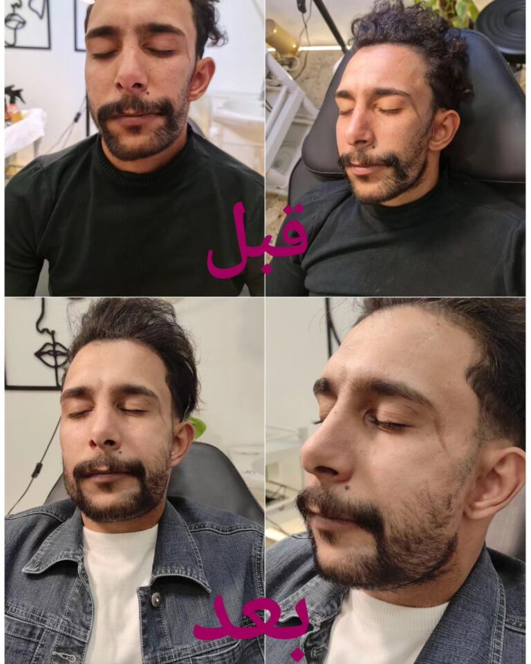 عمليه الفك 768x961