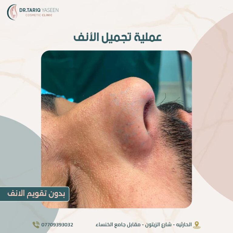 عمليه انف 768x768