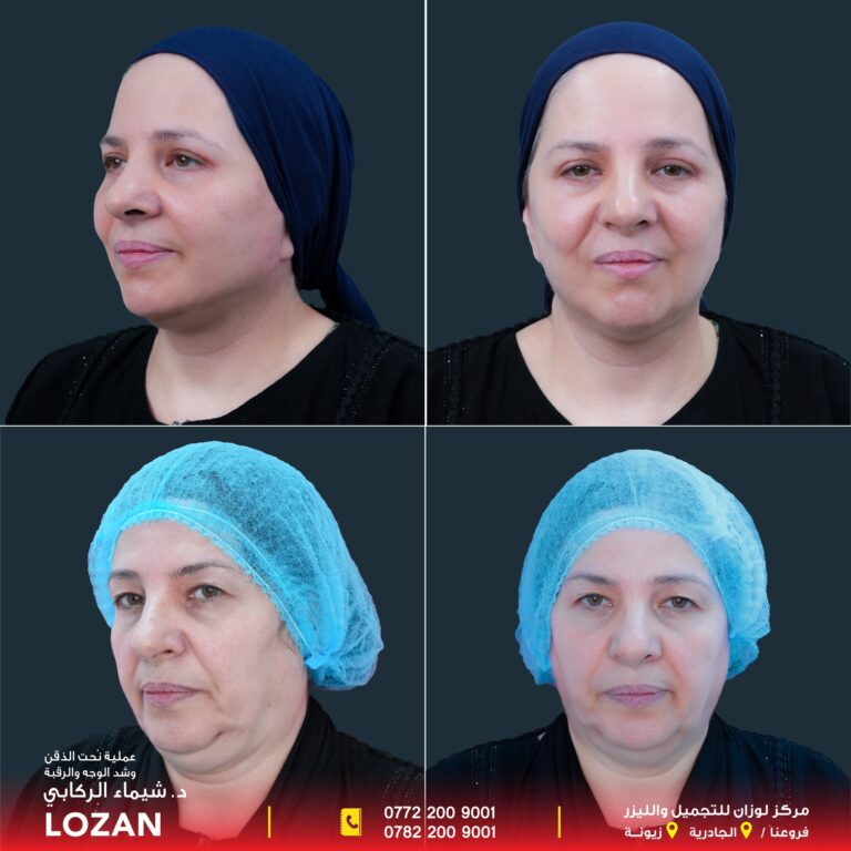 عمليه تحت الذق 768x768