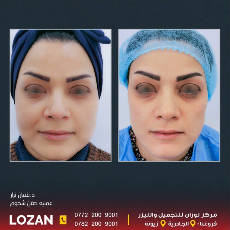 عمليه حقن شحوم 768x768