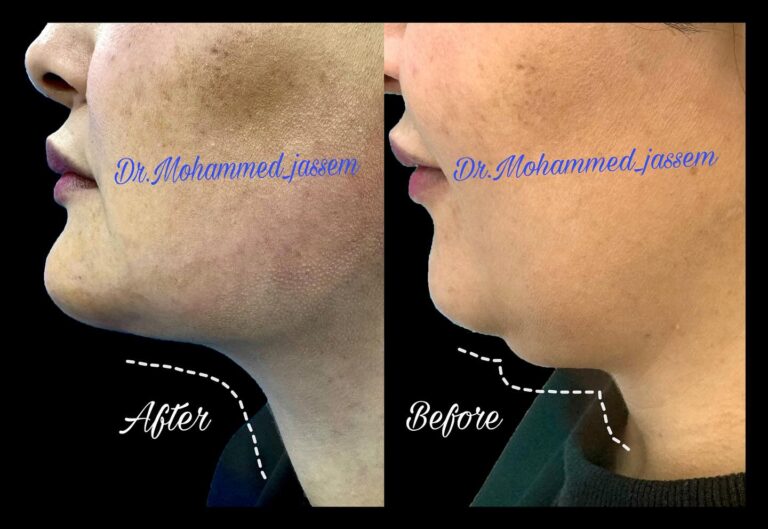 عمليه شفط الدهن 768x529