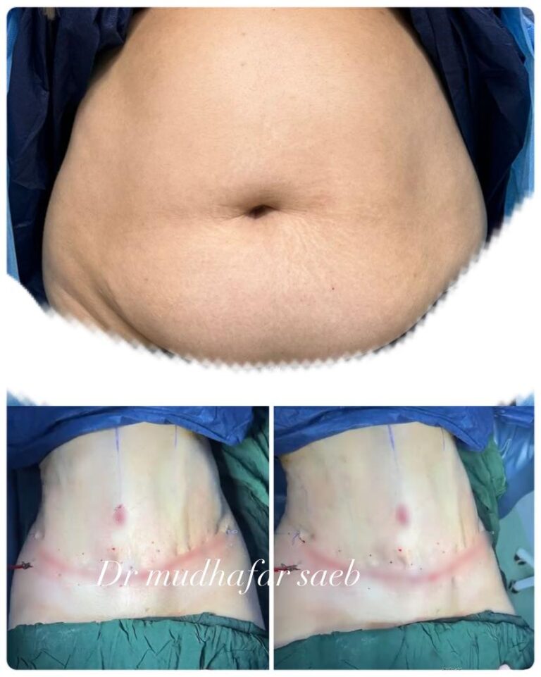 عمليه شفط وشد البط 768x961