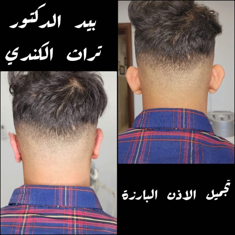 عميله تجميل الاذن 768x768