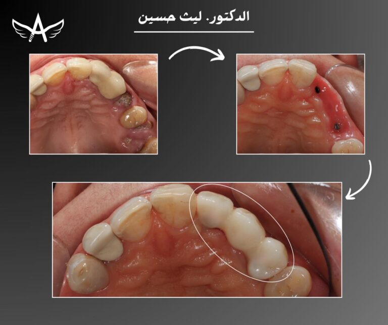 فبل وبعد الزراعه 1 768x644