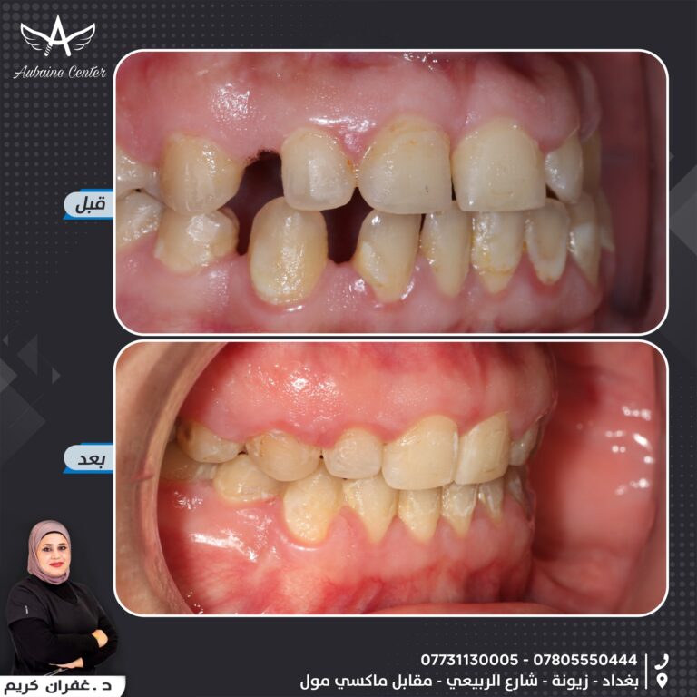 فراعات الاسنان 1 768x768