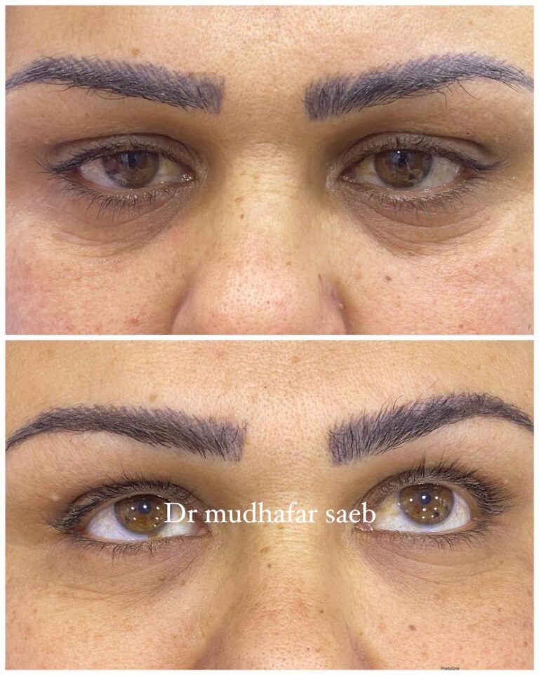 فلر اسفل العين 768x961