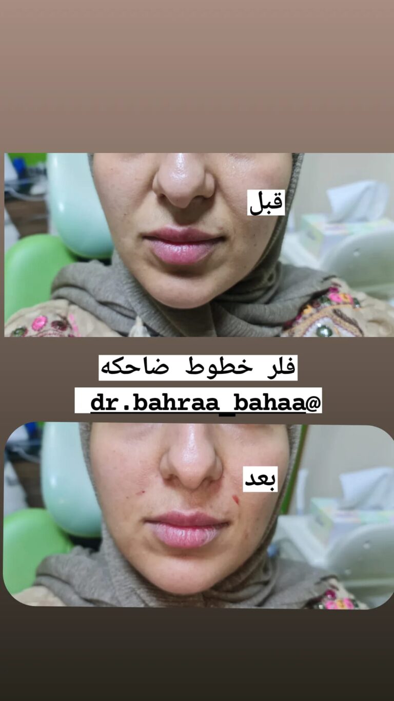 فلر الخطوط الضاحكه 1 768x1365