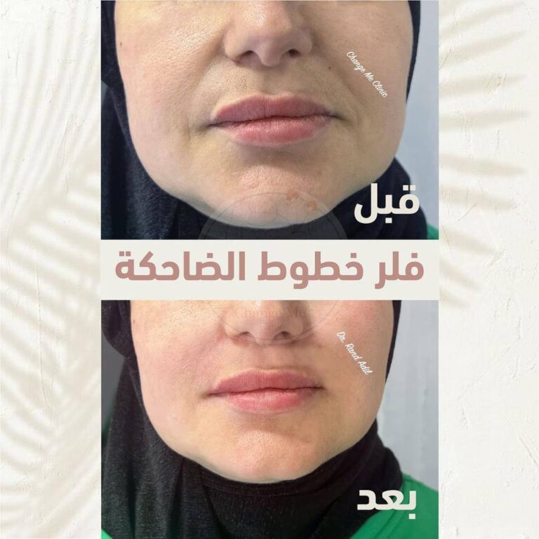 فلر الخطوط الضاحكه 768x768