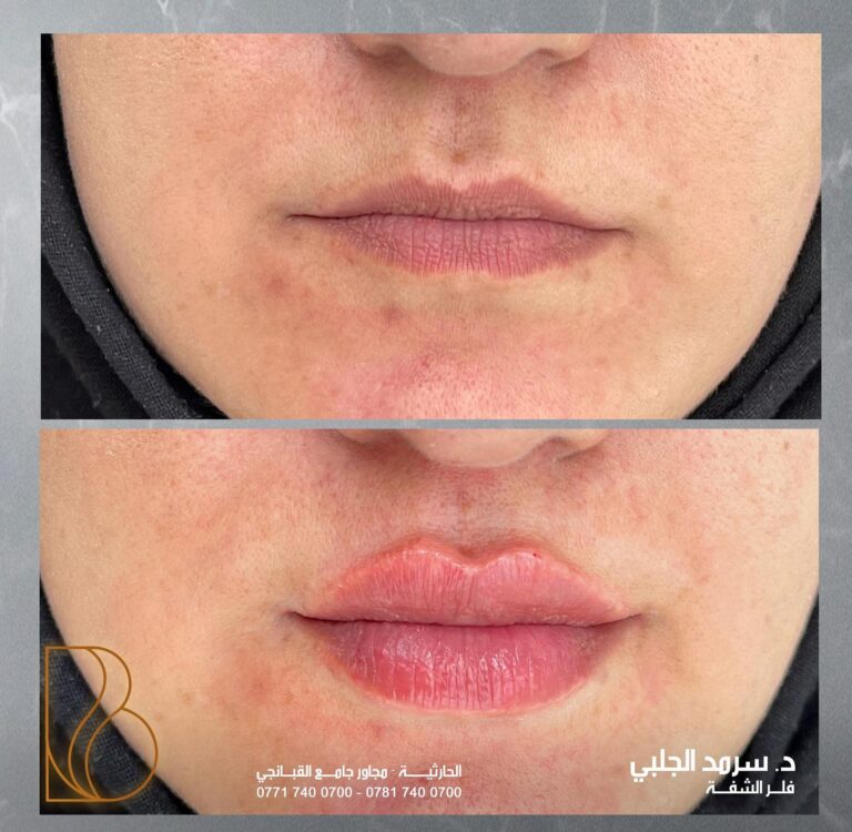 فلر الشفاه 768x750