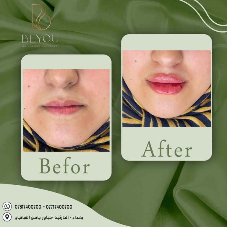 فلر الشفاه قبل وبعد 768x768