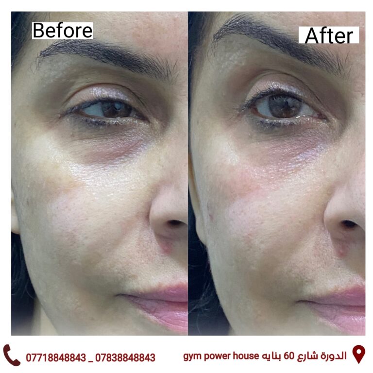فلر تحت العين 768x768