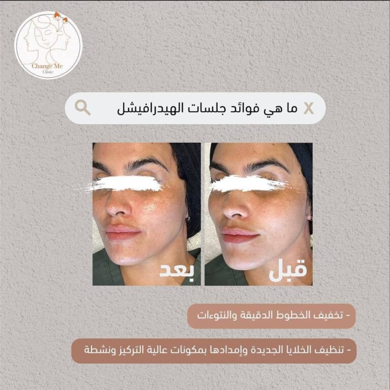 فلر تخفيف الخطوط 768x768