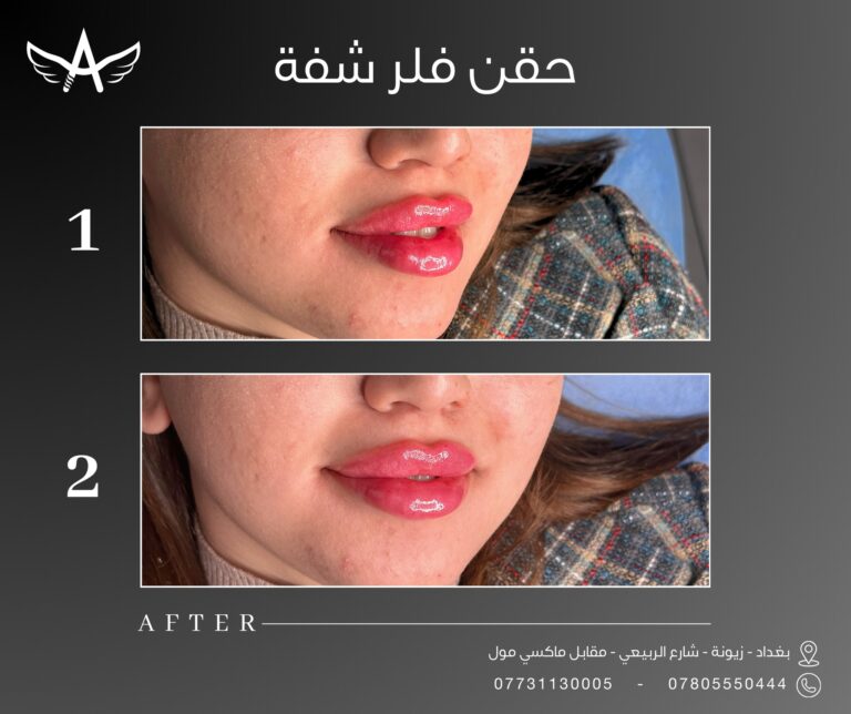 فلر شفاة 1 1 768x644