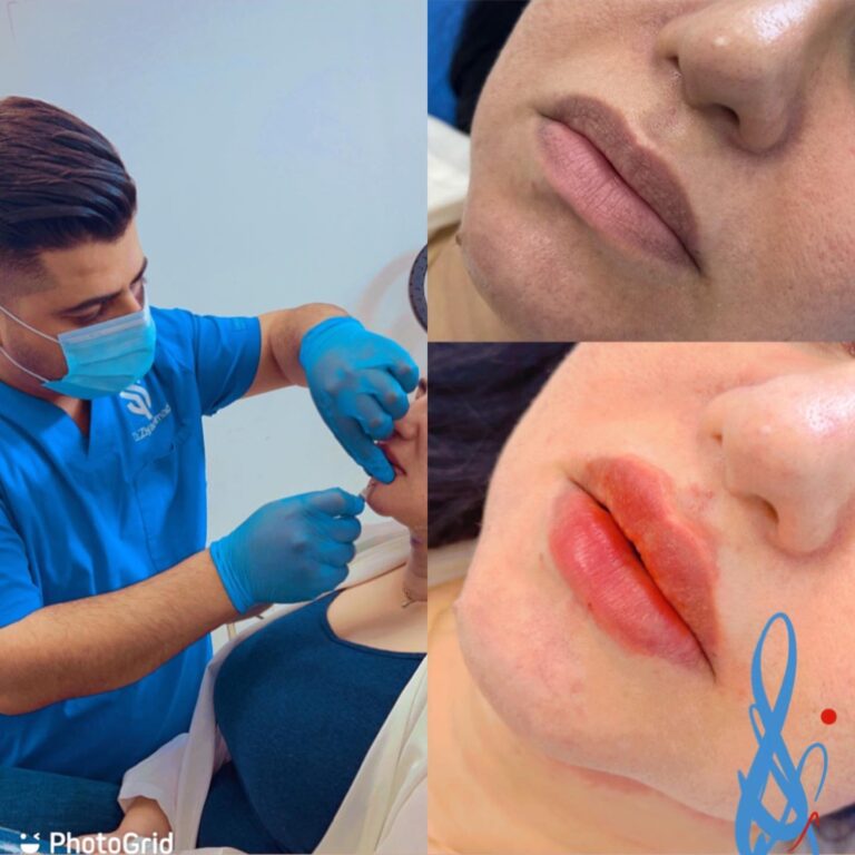 فلر شفاة 1 768x768