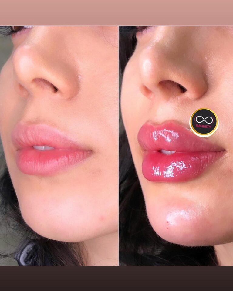 فلر شفاة 4 768x959