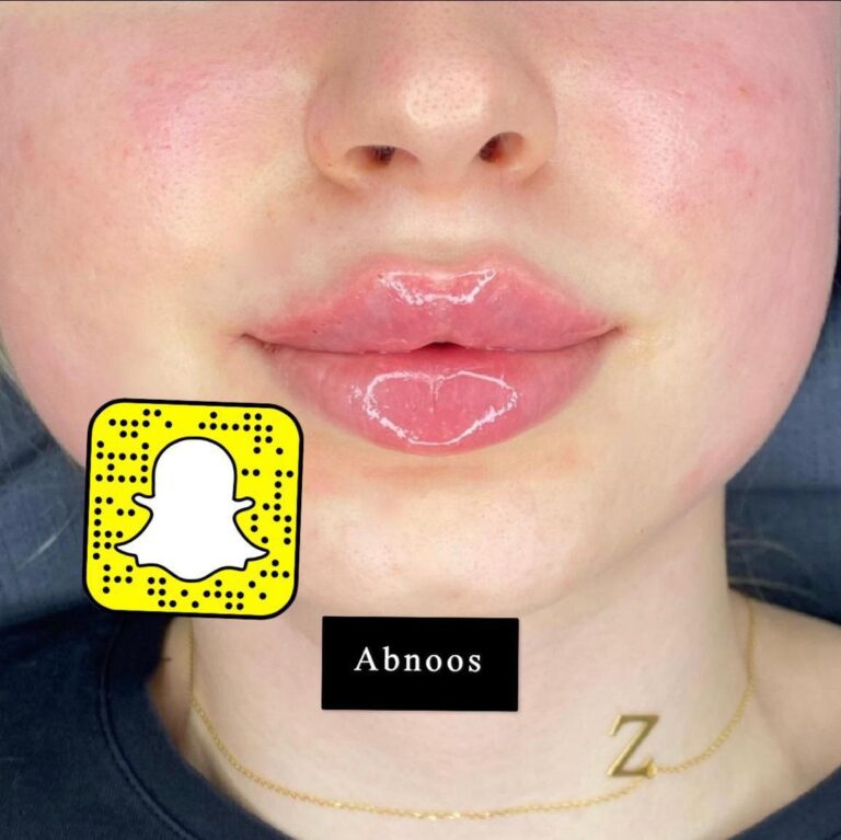 فلر شفاة 7 768x767