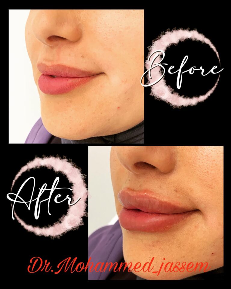 فلر شفاة 768x960