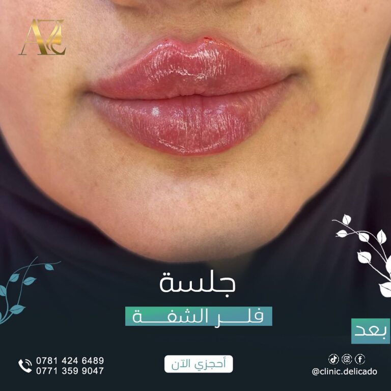 فلر شفاه 1 1 768x768