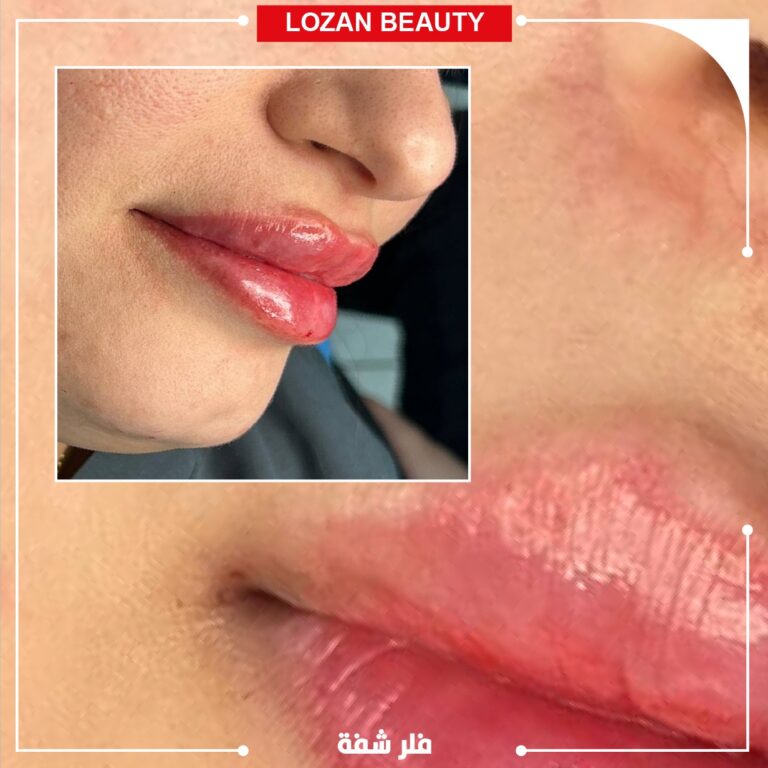 فلر شفاه 1 768x768