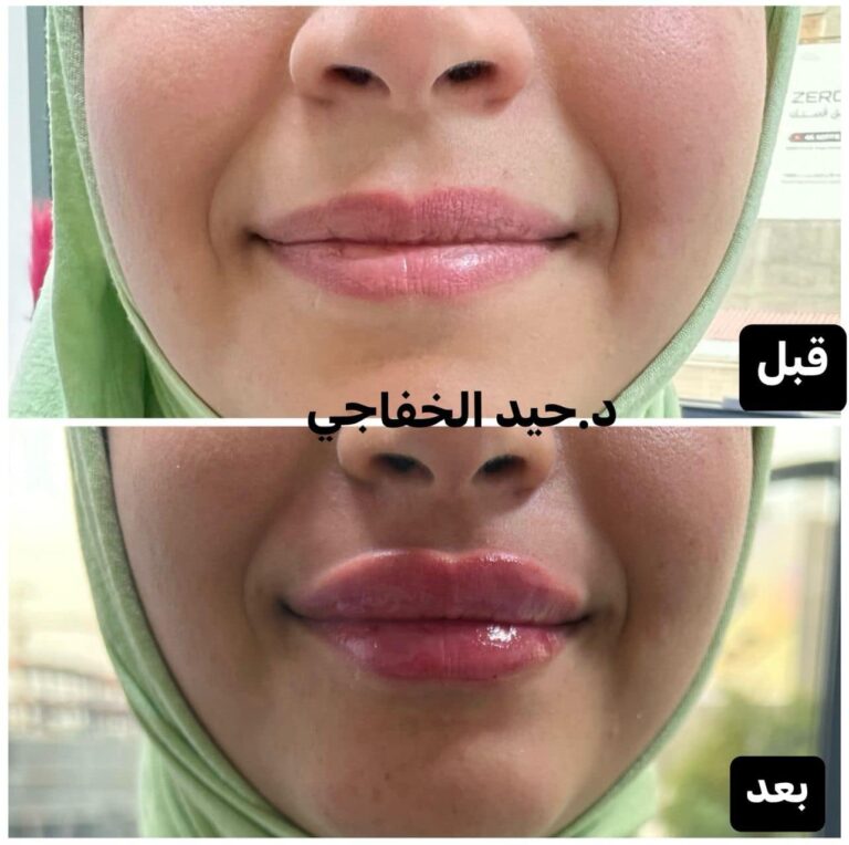 فلر شفاه 11 768x764