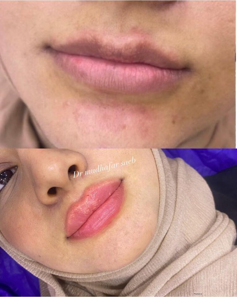 فلر شفاه 12 768x961