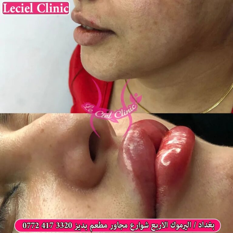 فلر شفاه 13 768x768