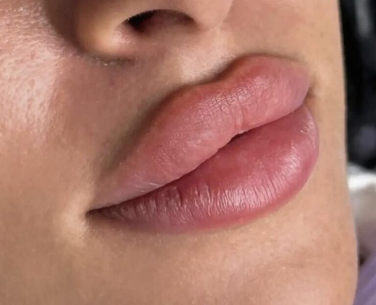 فلر شفاه 15 768x622