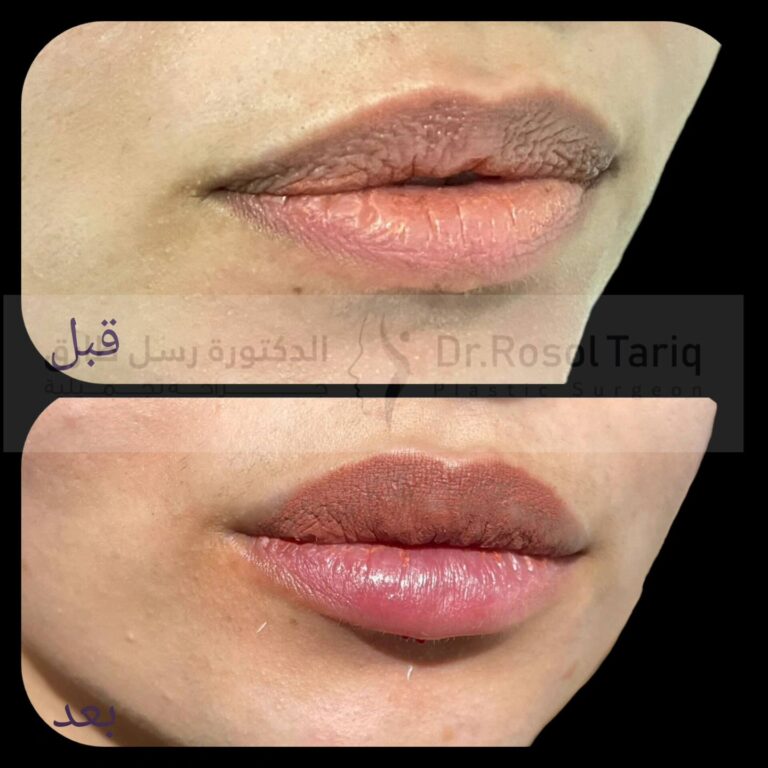 فلر شفاه 17 768x768