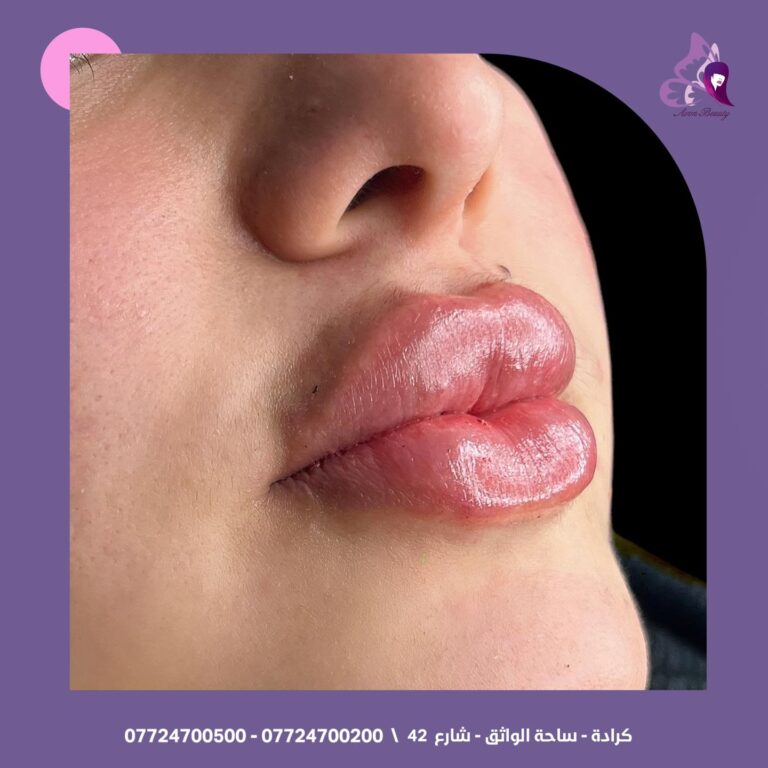 فلر شفاه 18 768x768