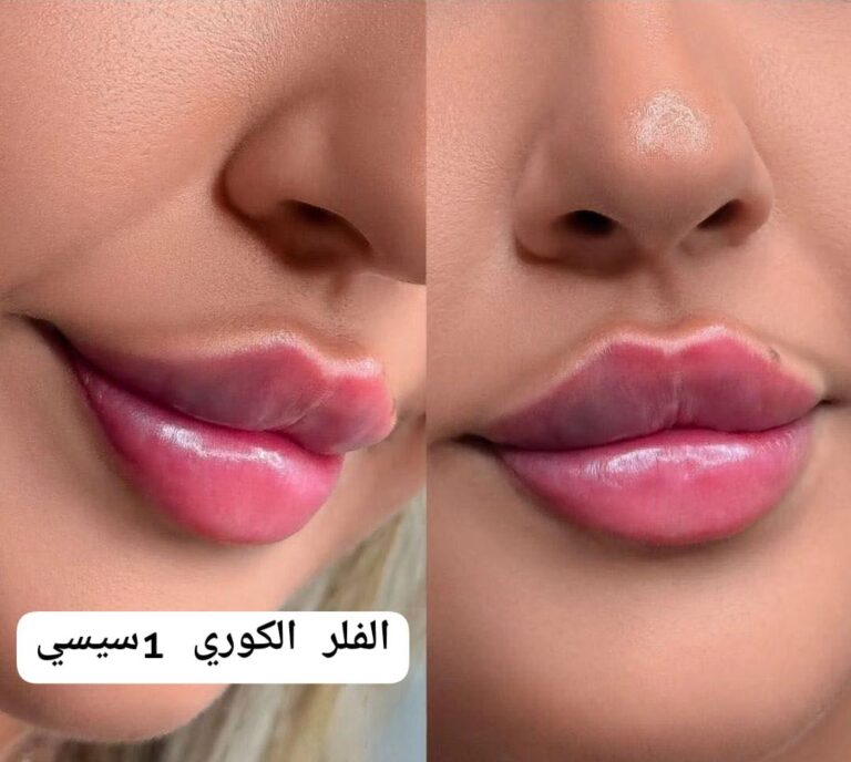 فلر شفاه 2 768x688