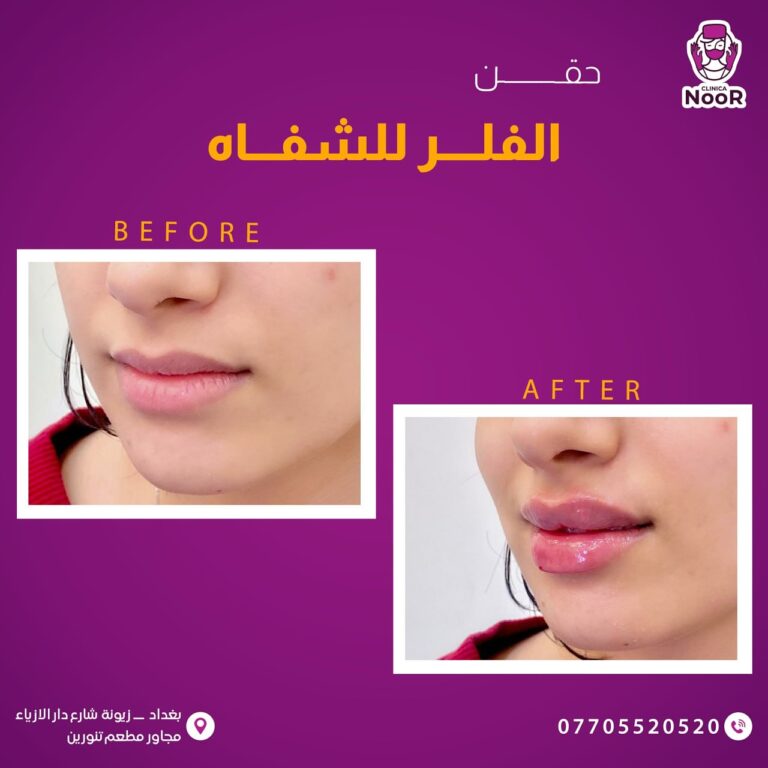 فلر شفاه 5 768x768