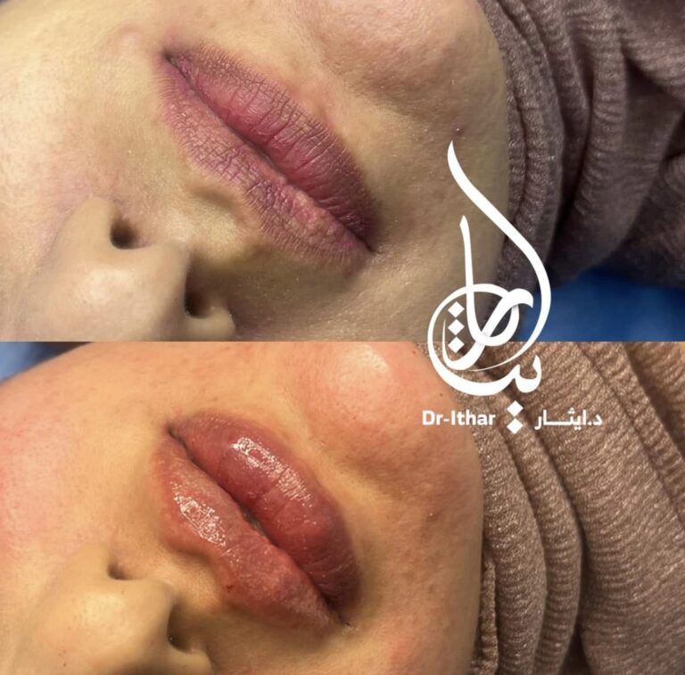 فلر شفاه 6 768x757