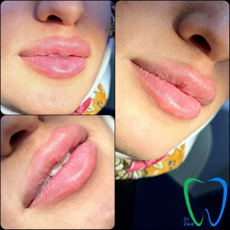 فلر شفاه 7 768x768