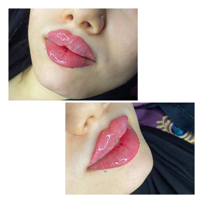 فلر شفاه 768x768