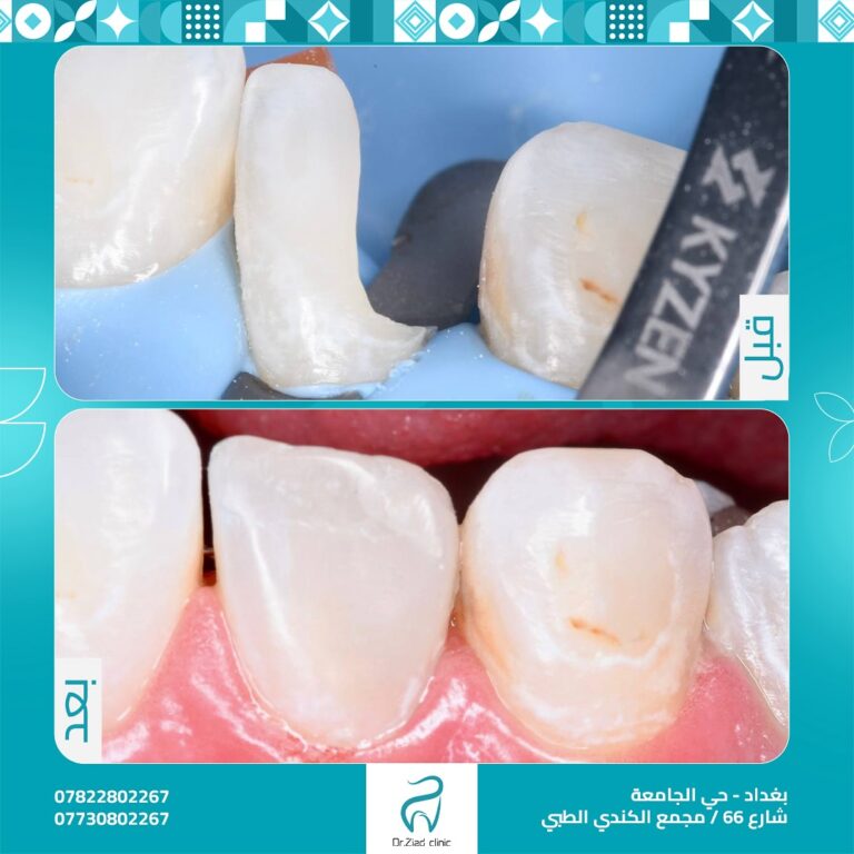 قبل وبعد 3 768x768