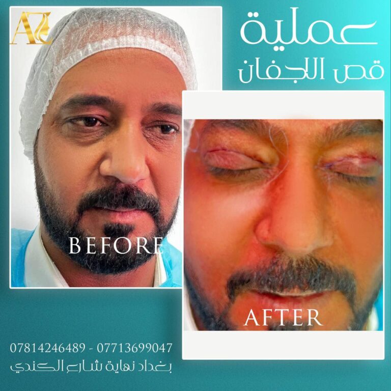 قص اجفان 1 1 768x768