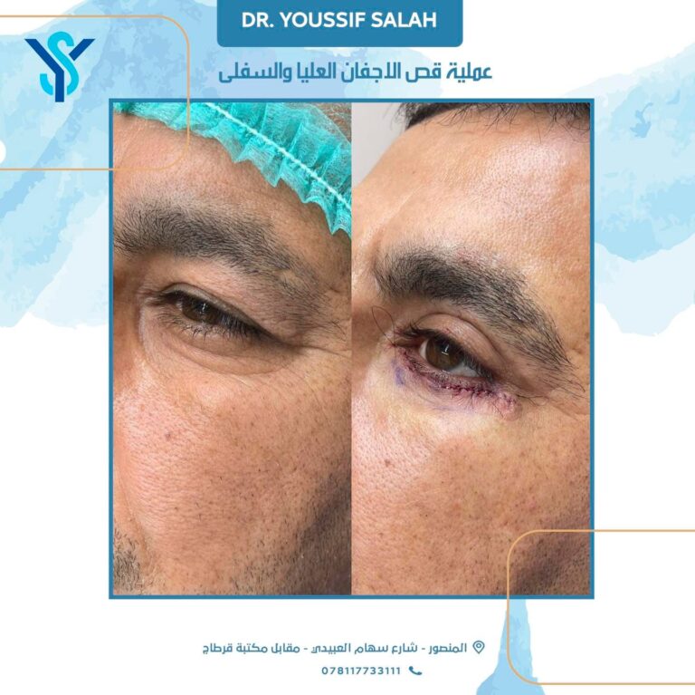 قص اجفان 1 2 768x767