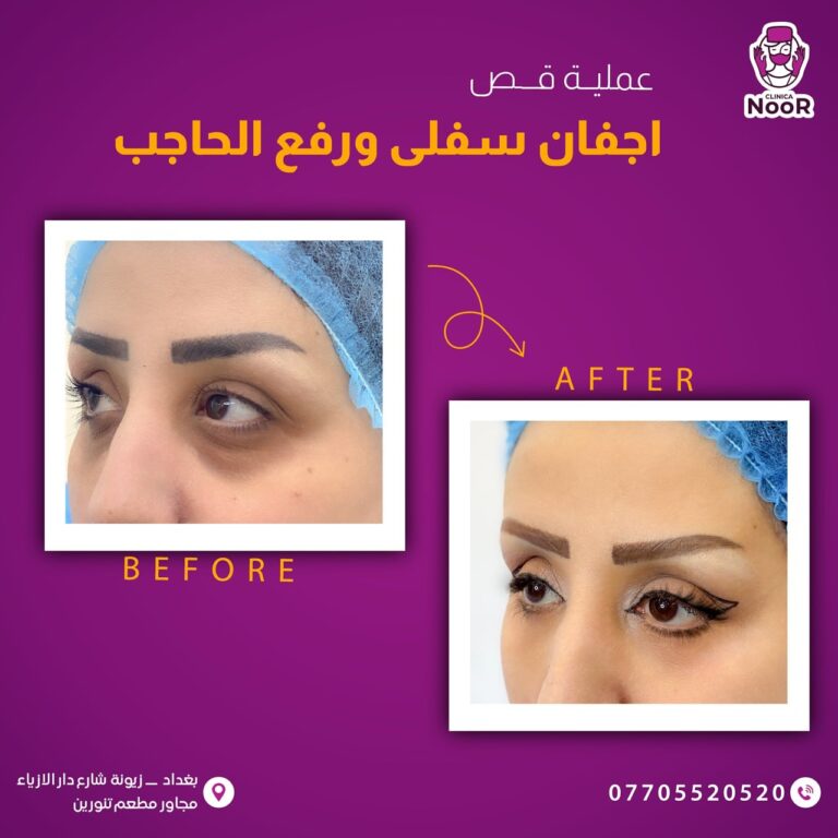 قص اجفان 1 768x768