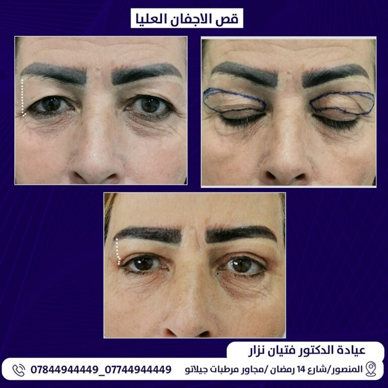 قص اجفان 768x768