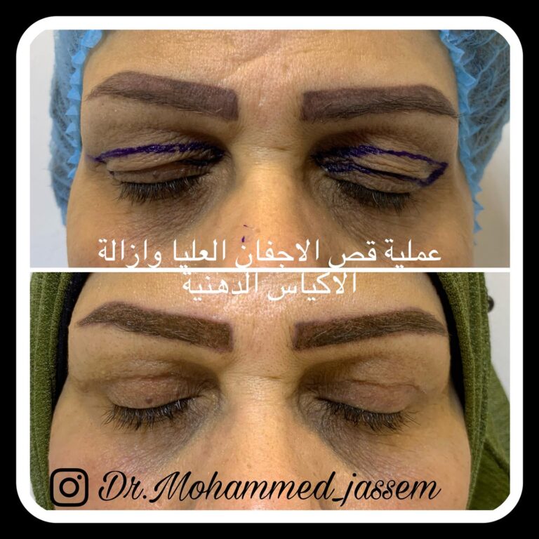 قص اجفان مع اكياس دهنيه 768x768