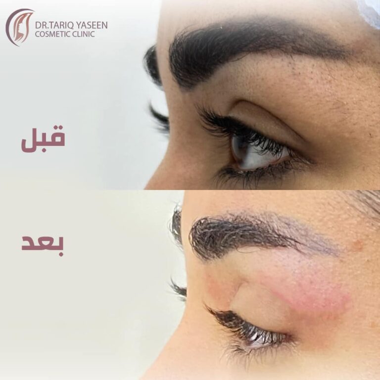 قص الاجفان 1 768x768