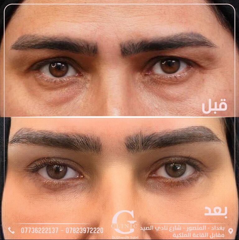 قص الاجفان 2 768x769