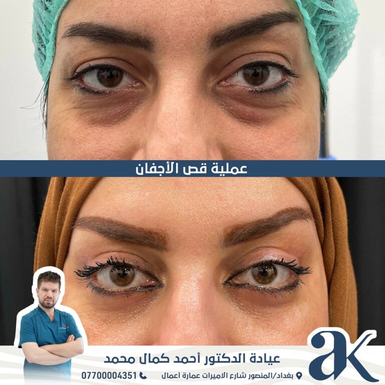 قص الاجفان 3 768x768