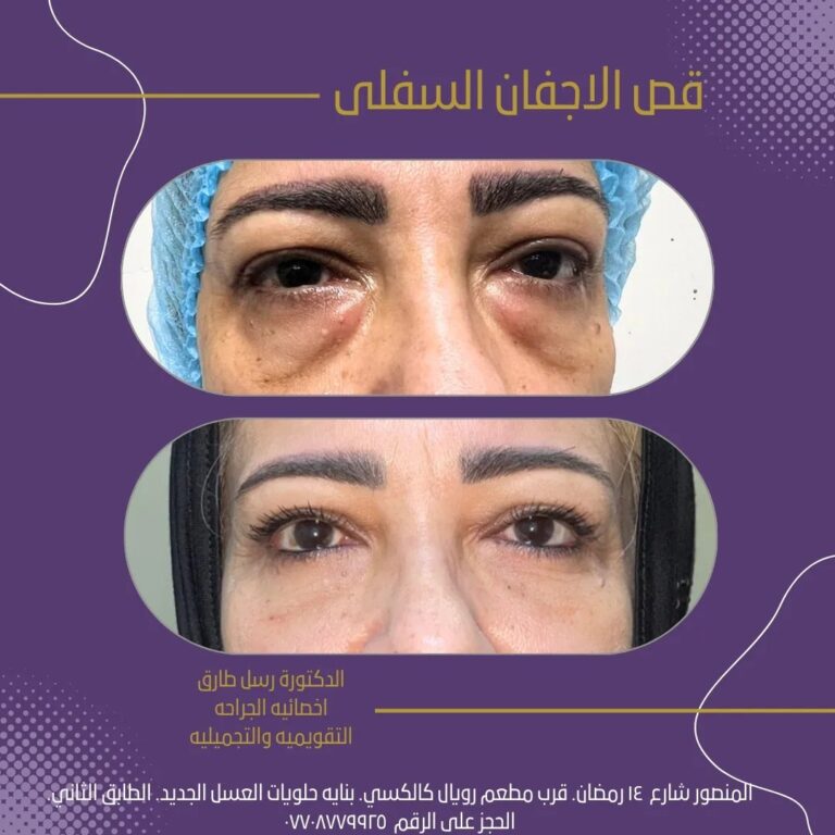 قص الاجفان 4 768x768